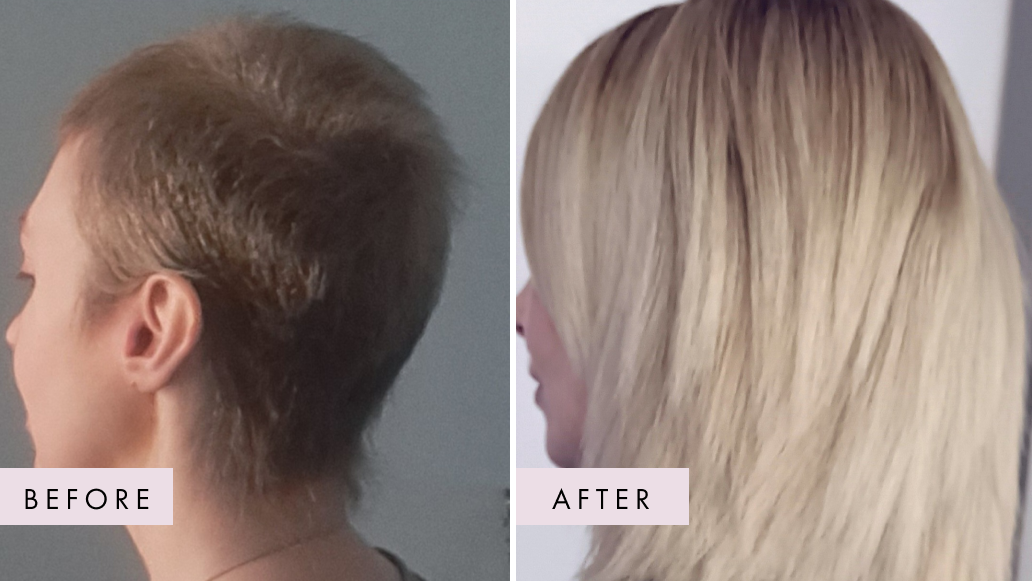 Hair Growth Before and After Picture with Hair Gain